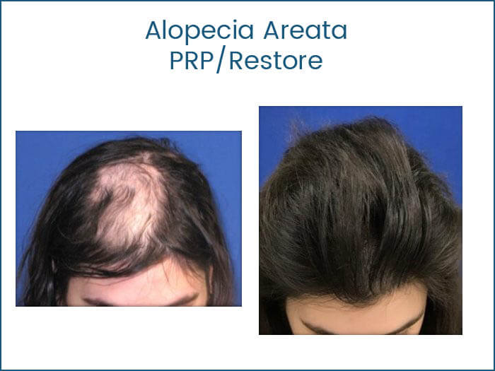 PRP Hair Transplants Florida