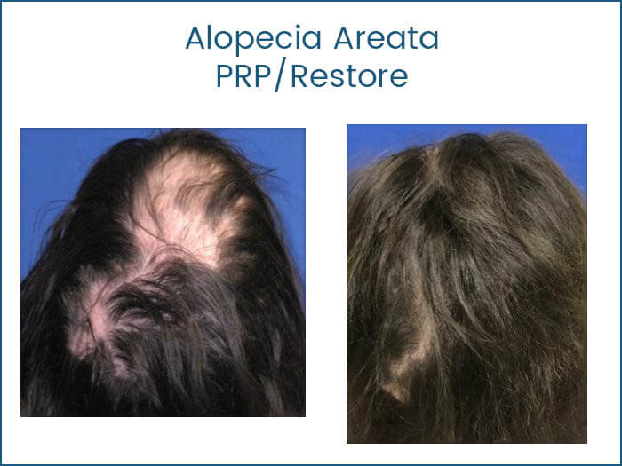 PRP Hair Transplants Florida