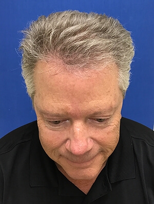 PRP Hair Transplants Florida