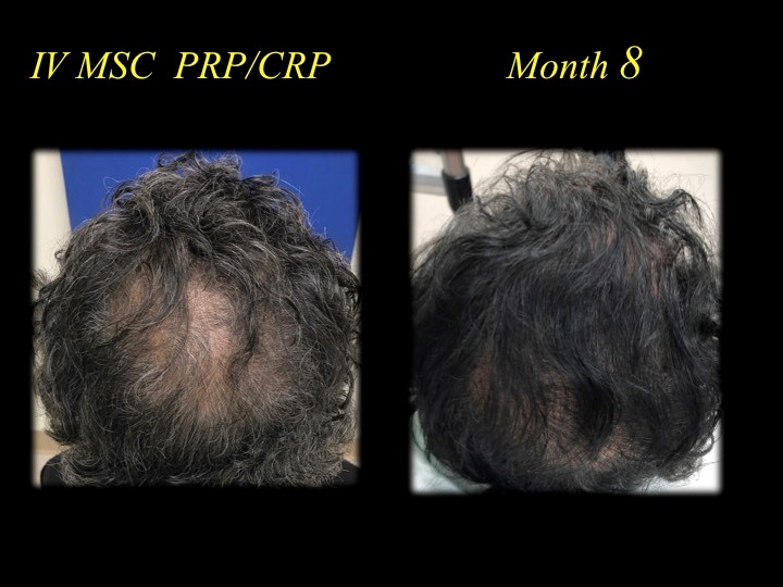 before and after picture of hair transplant