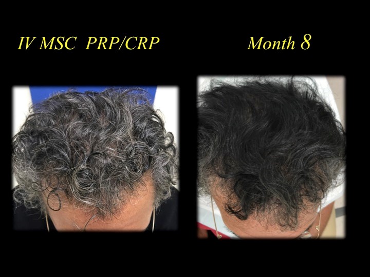 before and after picture of hair transplant