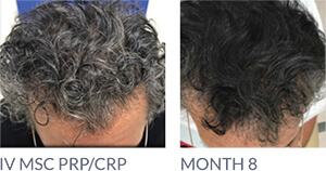 before and after hair restoration