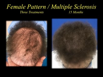 before and after picture of hair transplant