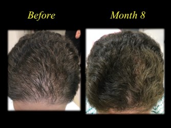 before and after picture of hair transplant