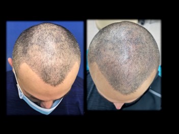 before and after picture of hair transplant