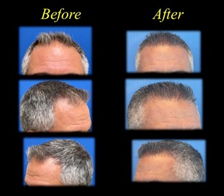 before and after hair restoration