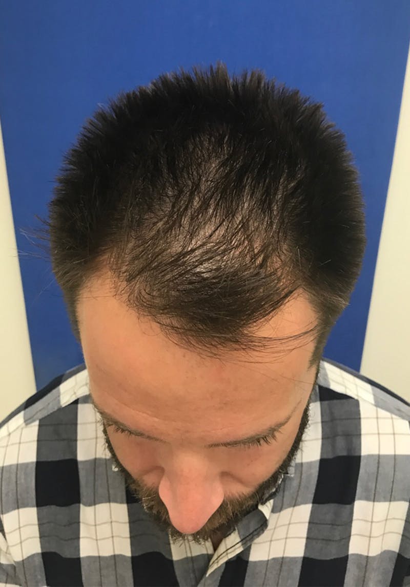 Male Surgical Gallery Before & After Gallery - Patient 179727398 - Image 3