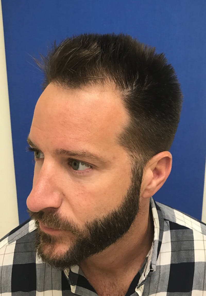 Male Surgical Gallery Before & After Gallery - Patient 179727398 - Image 5