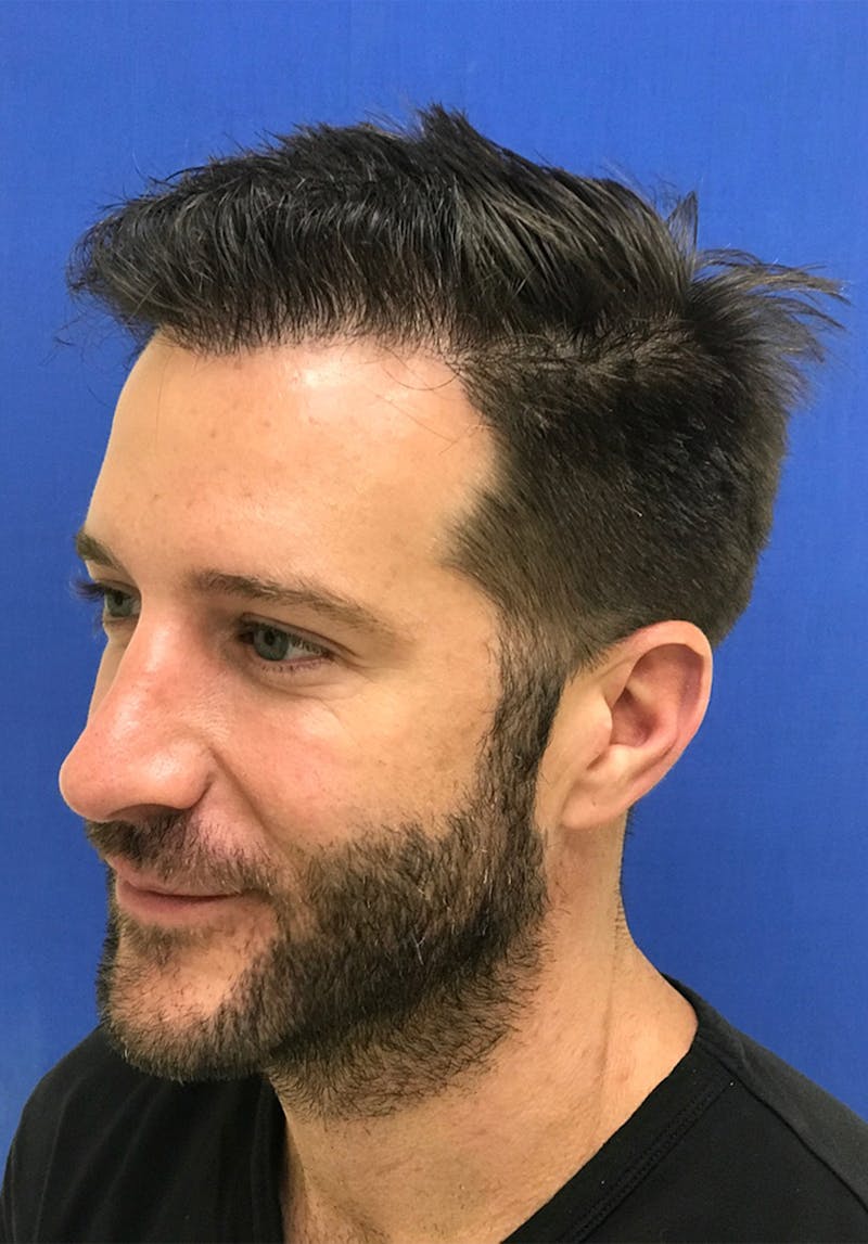 Male Surgical Gallery Before & After Gallery - Patient 179727398 - Image 6