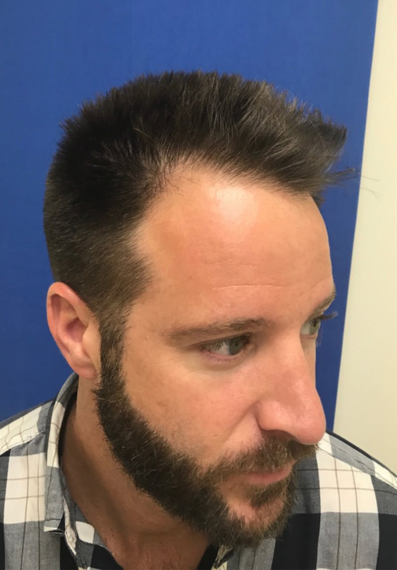 Male Surgical Gallery Before & After Gallery - Patient 179727398 - Image 7