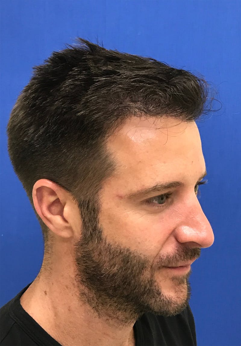Male Surgical Gallery Before & After Gallery - Patient 179727398 - Image 8