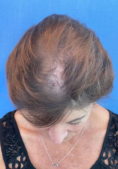 Non-Surgical Gallery Before & After Gallery - Patient 179729609 - Image 1