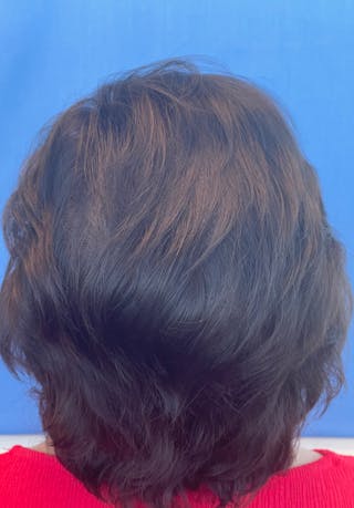 Non-Surgical Gallery Before & After Gallery - Patient 179729609 - Image 4