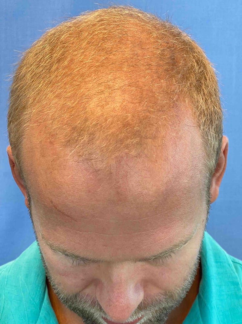 Male Surgical Gallery Before & After Gallery - Patient 179730846 - Image 3