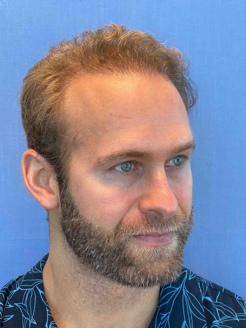 Male Surgical Gallery Before & After Gallery - Patient 179730846 - Image 6