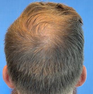 Non-Surgical Gallery Before & After Gallery - Patient 179730905 - Image 2