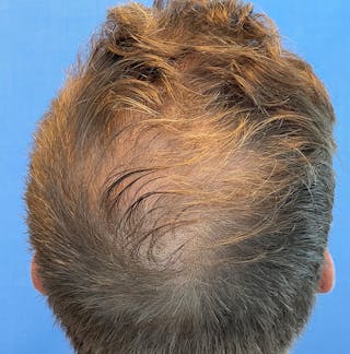 Non-Surgical Gallery Before & After Gallery - Patient 179730905 - Image 4