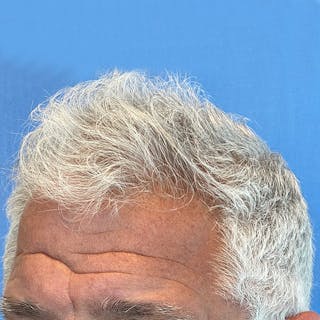 Non-Surgical Gallery Before & After Gallery - Patient 179737922 - Image 4