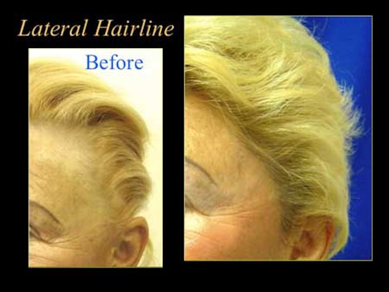 before and after hairline restoration