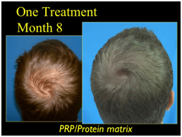 before and after hair restoration