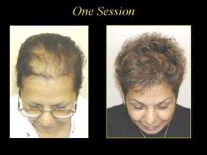 before and after hair restoration