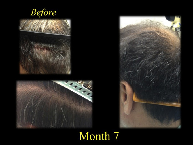 before and after hair restoration