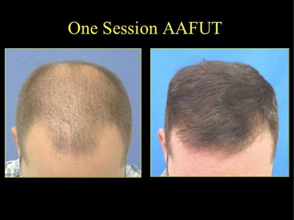 before and after hair restoration