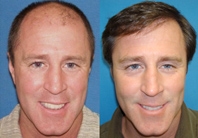 before and after hair restoration