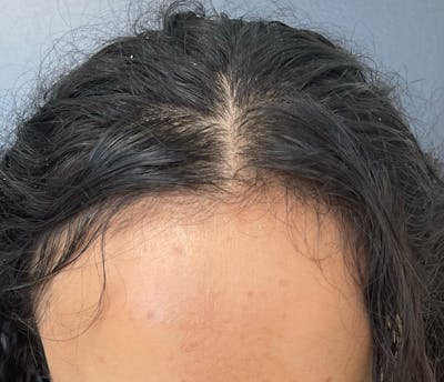 Non-Surgical Gallery Before & After Gallery - Patient 179729931 - Image 1