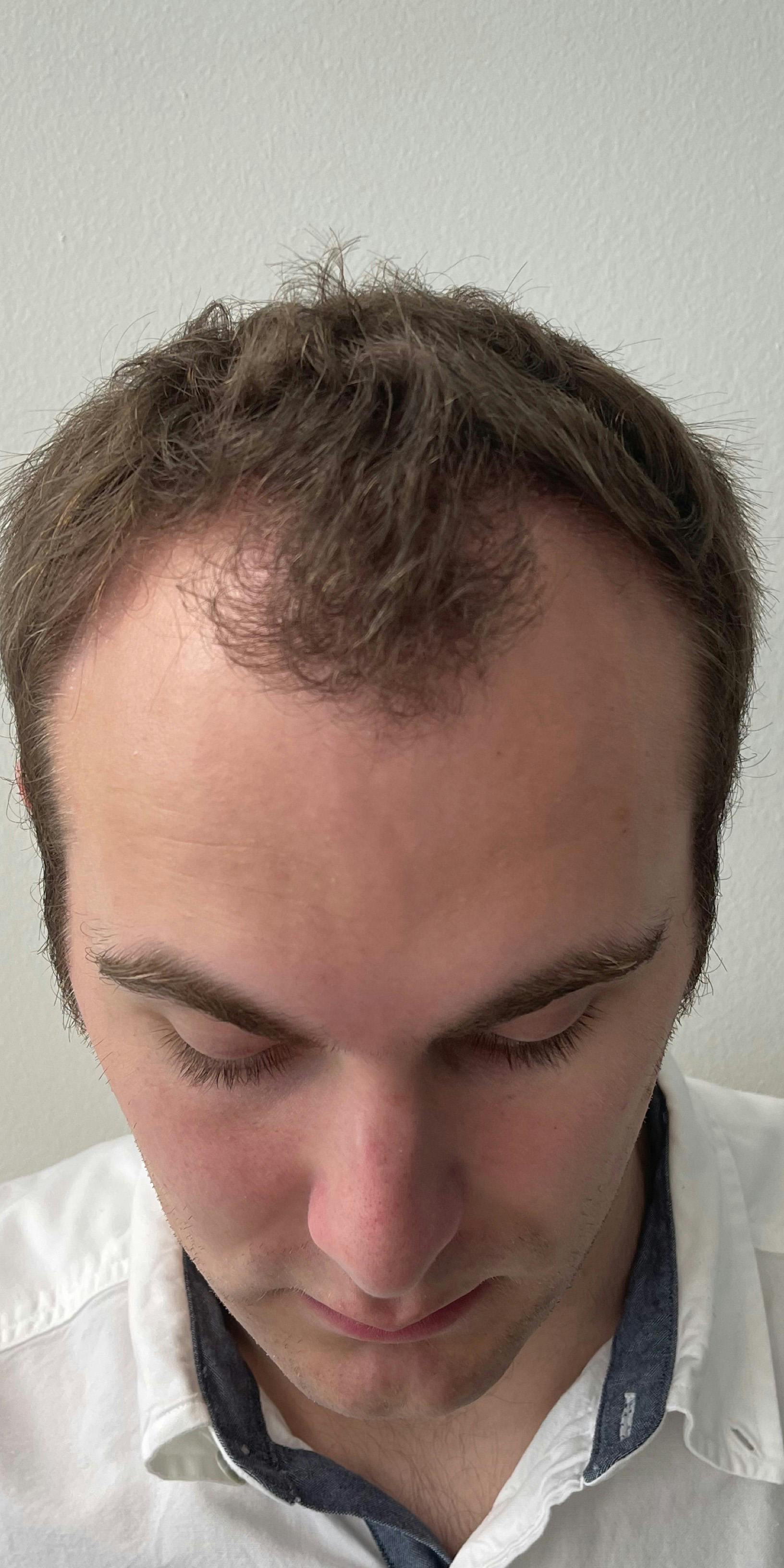 Fue Before & After