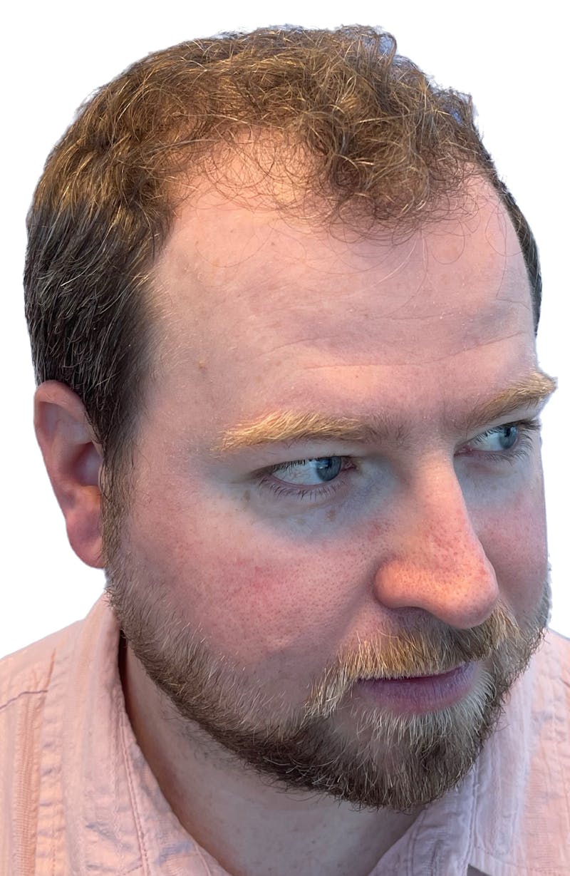Male Surgical Gallery Before & After Gallery - Patient 188597764 - Image 3