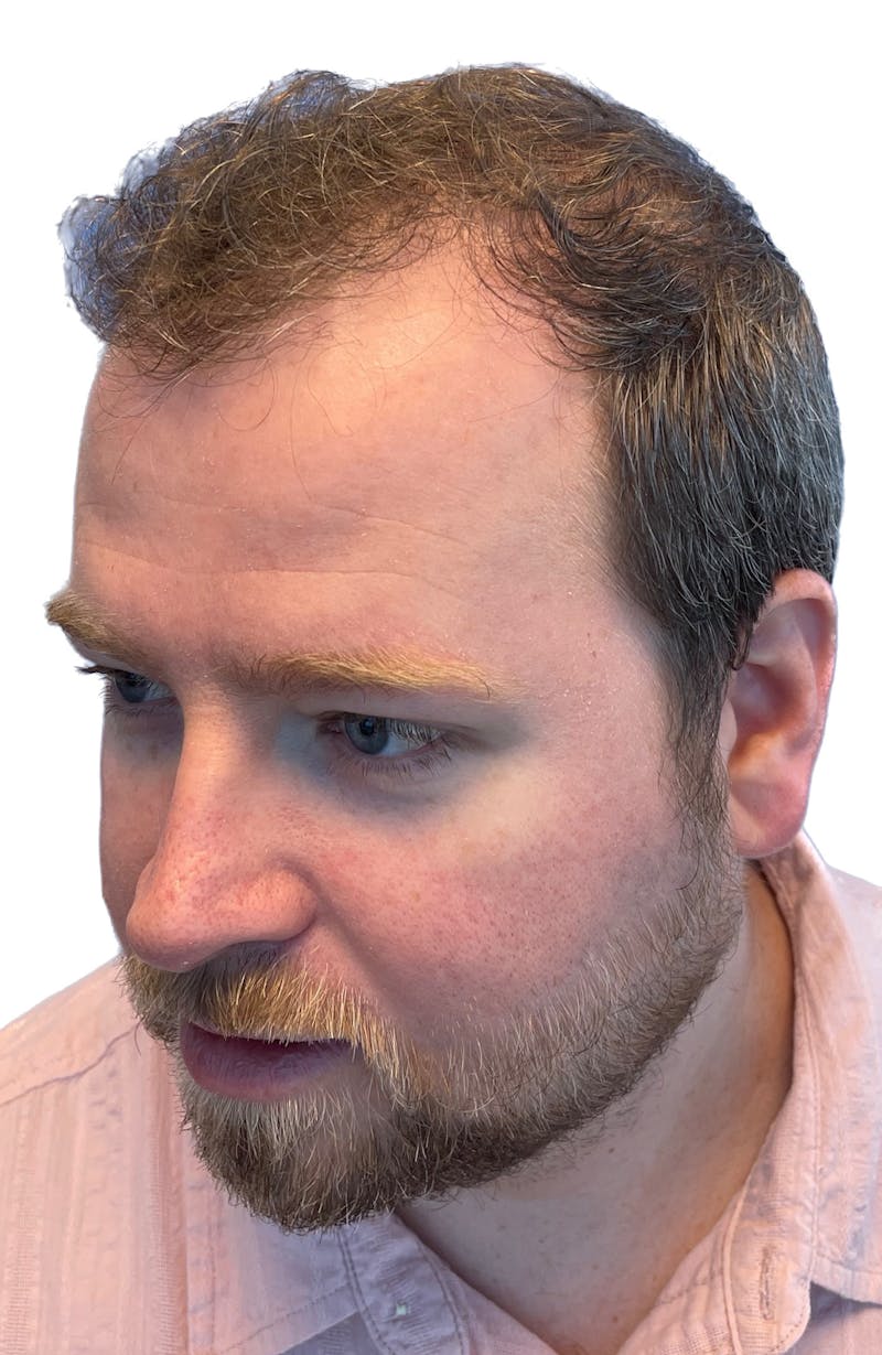 Male Surgical Gallery Before & After Gallery - Patient 188597764 - Image 5
