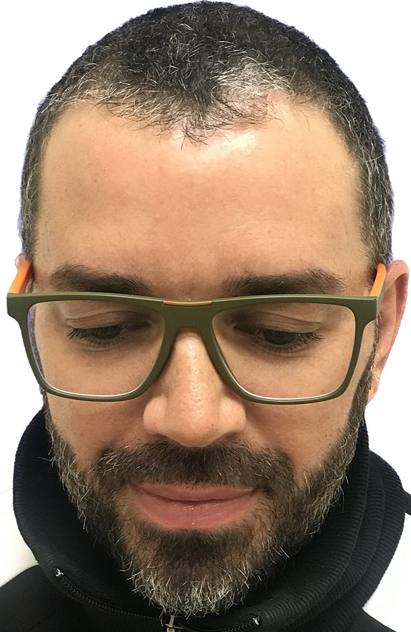 FUT Before & After