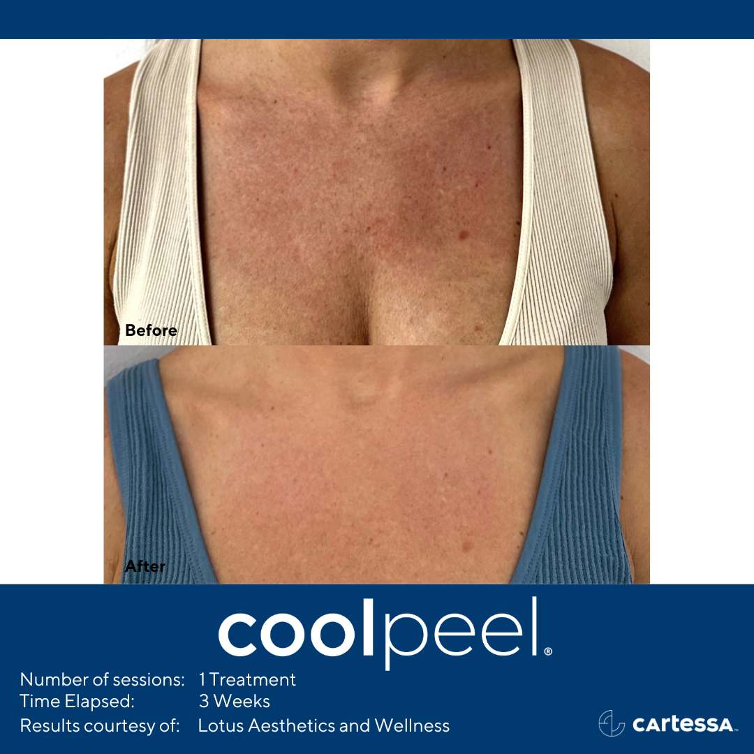 CoolPeel before and after of the chest