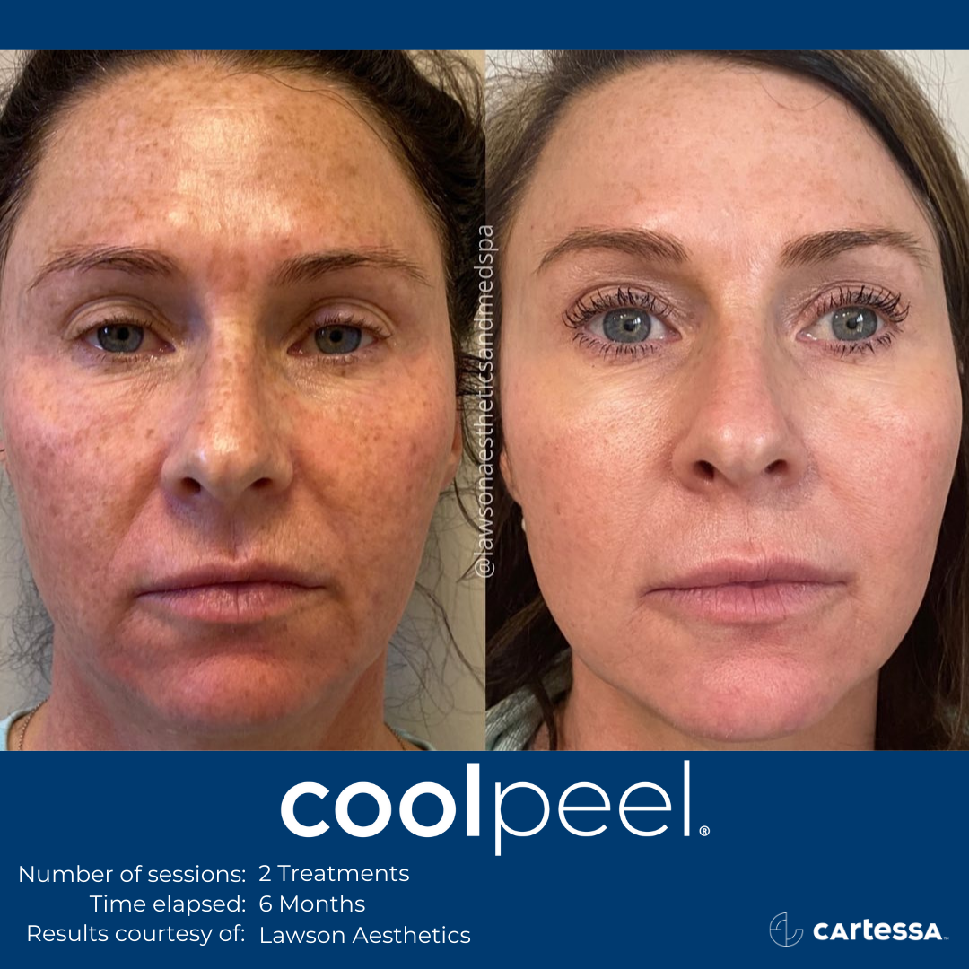 Coolpeel befor and after