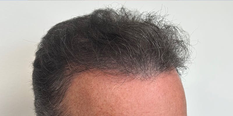 Male Surgical Gallery Before & After Gallery - Patient 195958379 - Image 6