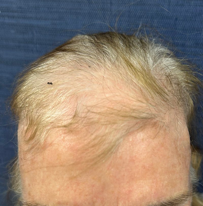 Non-Surgical Gallery Before & After Gallery - Patient 304169 - Image 1