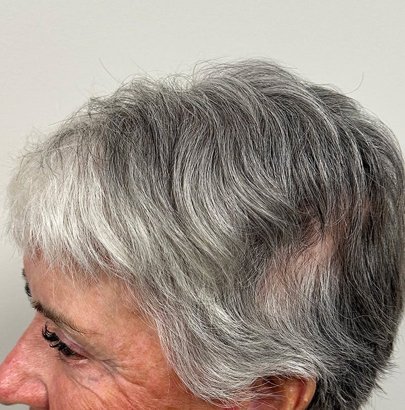Non-Surgical Gallery Before & After Gallery - Patient 304169 - Image 6