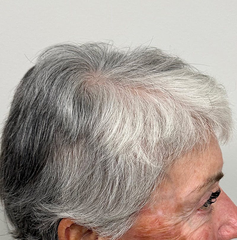 Non-Surgical Gallery Before & After Gallery - Patient 304169 - Image 4