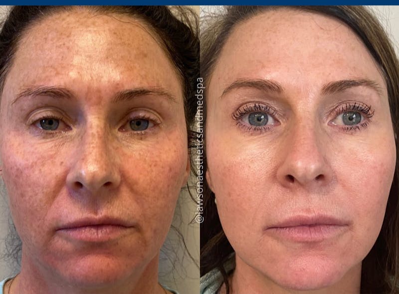 skin treatment before and after