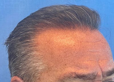 Non-Surgical Gallery Before & After Gallery - Patient 507374 - Image 2