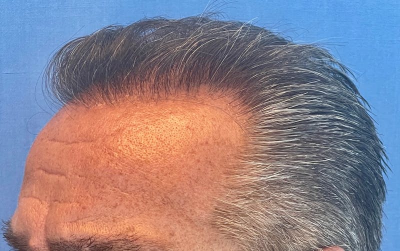 Non-Surgical Gallery Before & After Gallery - Patient 507374 - Image 4