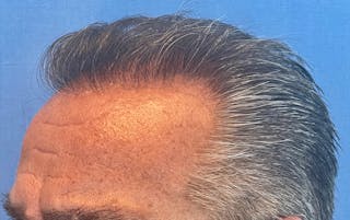 Non-Surgical Gallery Before & After Gallery - Patient 507374 - Image 4