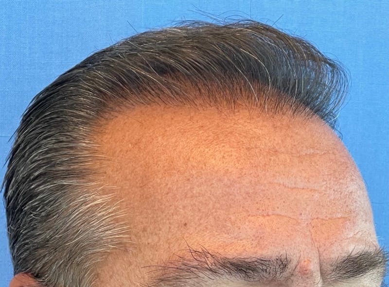 Non-Surgical Gallery Before & After Gallery - Patient 507374 - Image 1