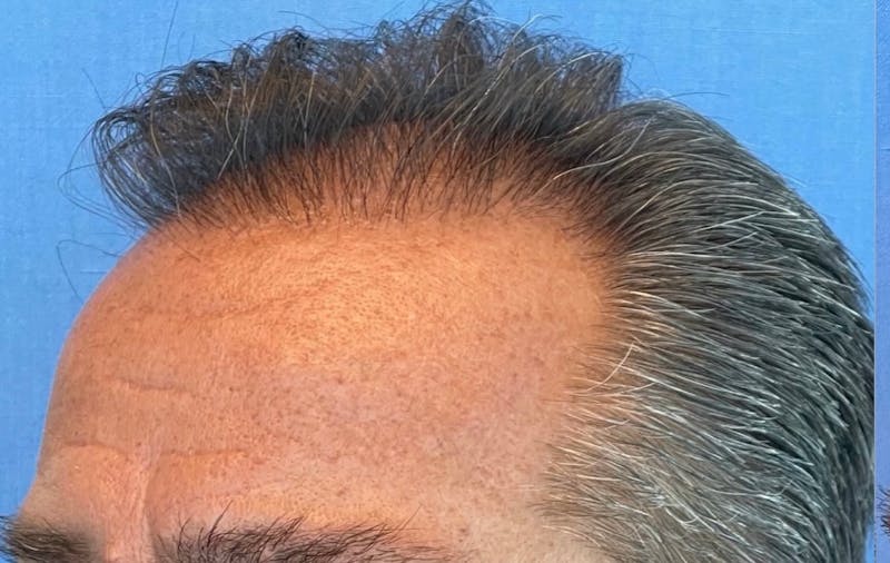 Non-Surgical Gallery Before & After Gallery - Patient 507374 - Image 3