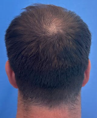 Non-Surgical Gallery Before & After Gallery - Patient 349593 - Image 4