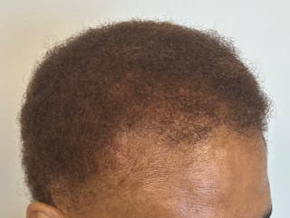 Non-Surgical Gallery Before & After Gallery - Patient 383259 - Image 6