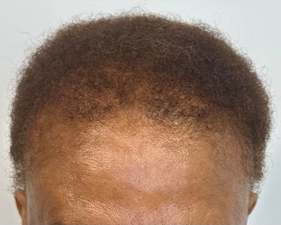 Non-Surgical Gallery Before & After Gallery - Patient 383259 - Image 2