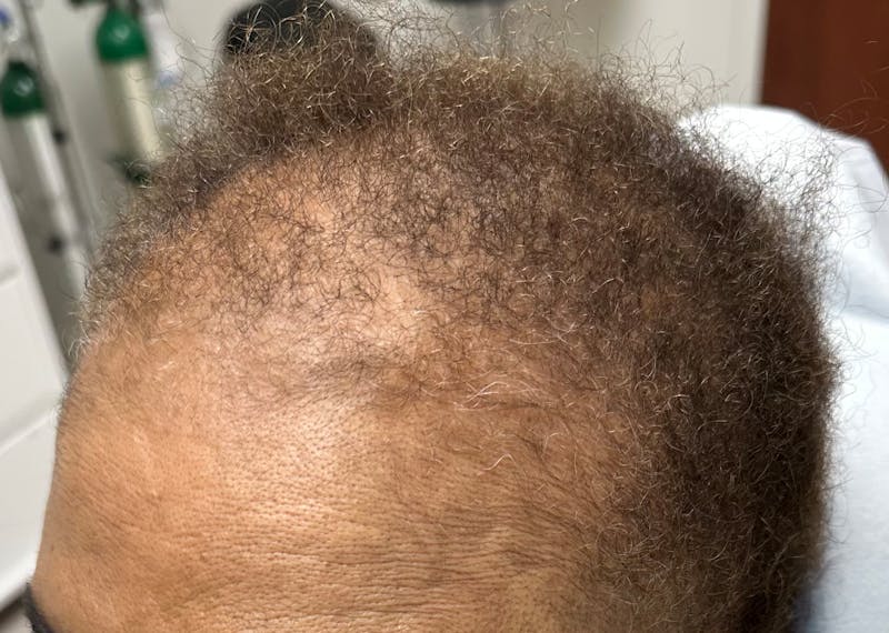 Non-Surgical Gallery Before & After Gallery - Patient 383259 - Image 7