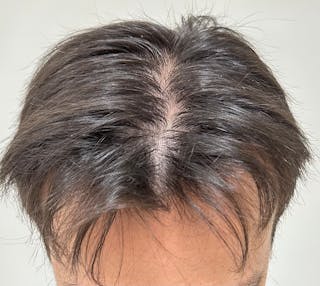 Non-Surgical Gallery Before & After Gallery - Patient 160987 - Image 2